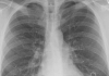 Akciğer Kanserine Karşı Yeni Umut! 'İhtimal Vermediğimiz Hastalar İyileşiyor!'